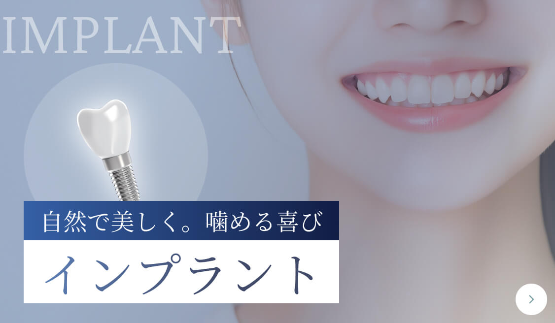 インプラント